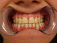 pacjentka po leczeniu ortodontycznym