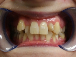 pacjentka przed leczeniem ortodontycznym