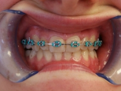 pacjentka w trakcie leczenia ortodontycznego