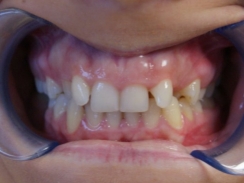 pacjentka przed leczeniem ortodontycznym