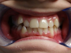pacjent przed leczeniem ortodontycznym