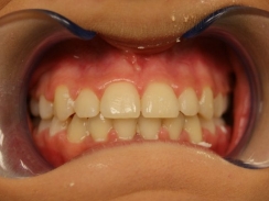 pacjent po leczeniu ortodontycznym