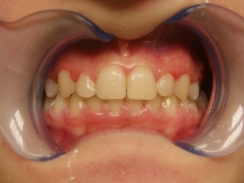 pacjent po leczeniu ortodontycznym