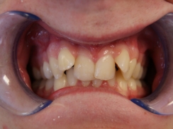 pacjent przed leczeniem ortodontycznym