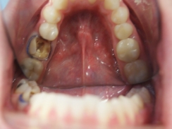 ząb trzonowy przed odbudową