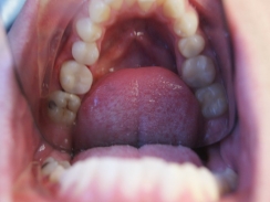 ząb trzonowy po odbudowie