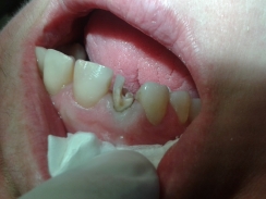 Zniszczony ząb - pilna sprawa dla pacjentki
